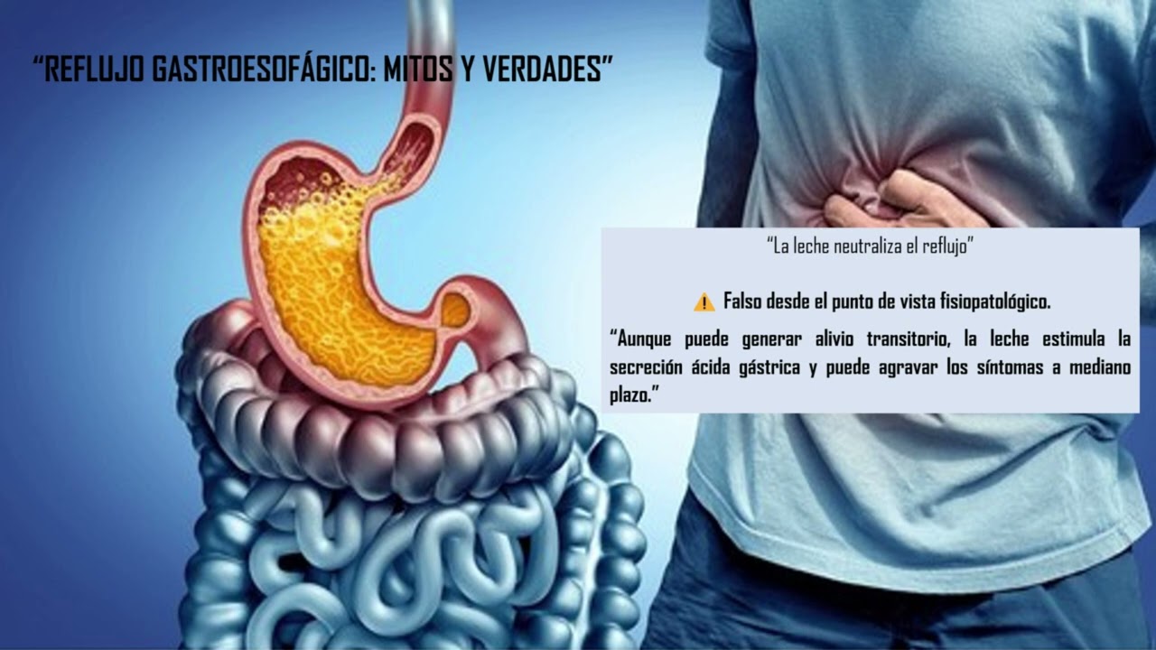 Reflujo gastroesofágico: mitos y verdades.