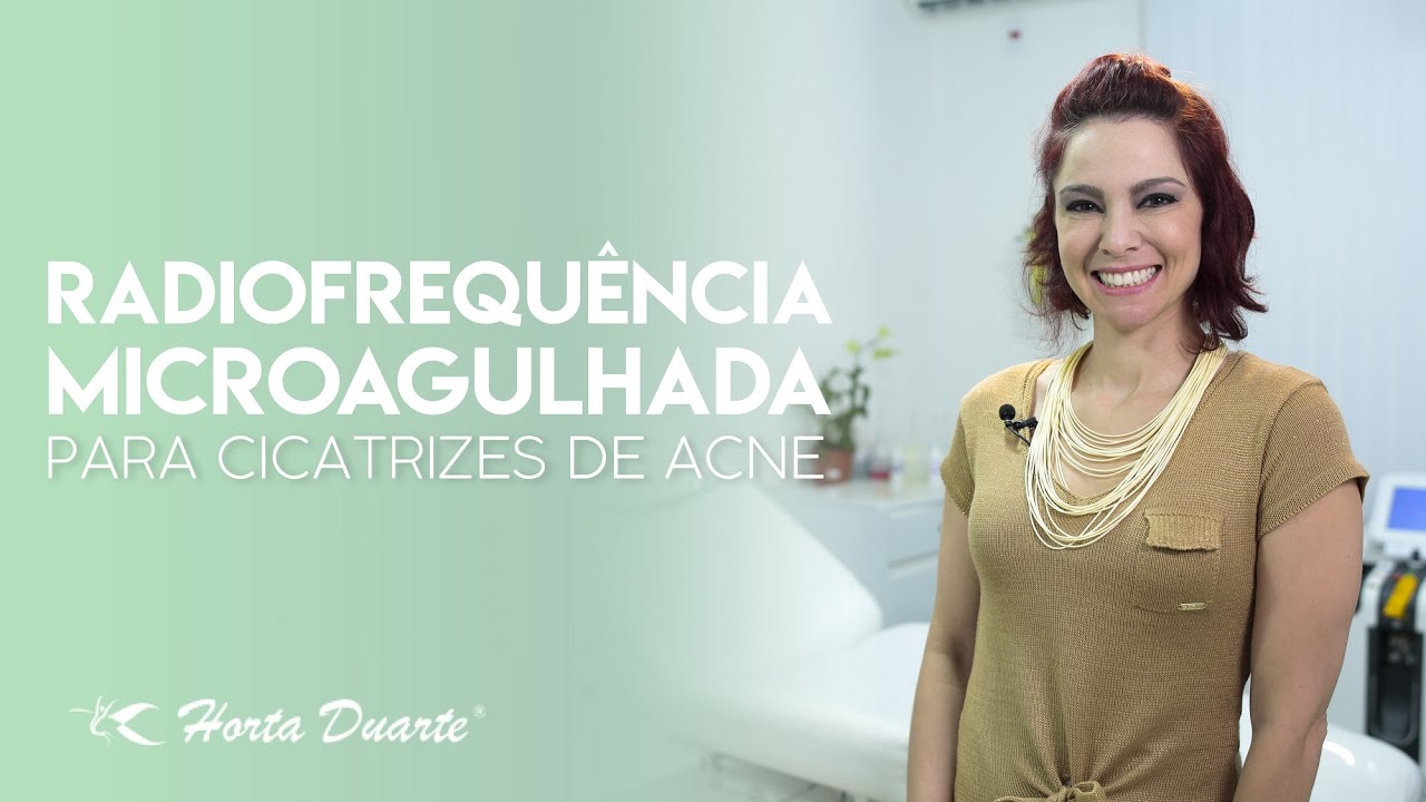 Radiofrequência microagulhada: tratando cicatrizes de acne