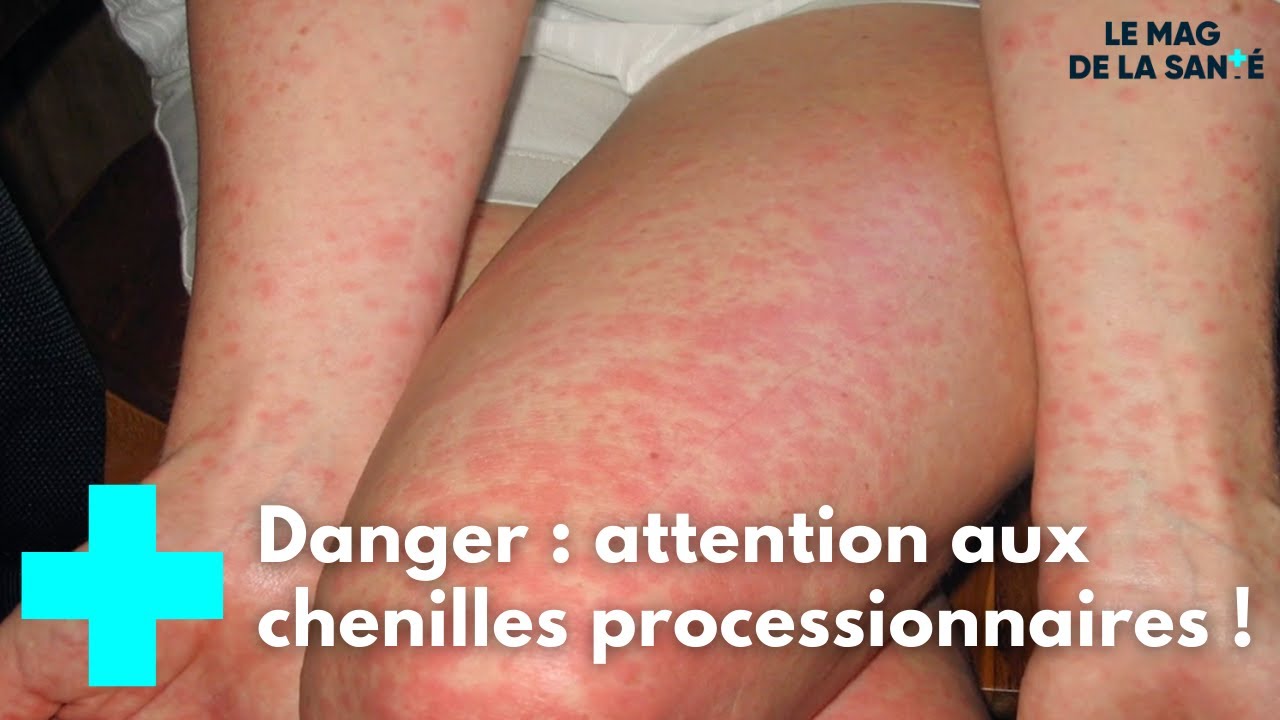 Chenilles processionnaires : attention, danger ! - Le Magazine de la Sant&eacute;
