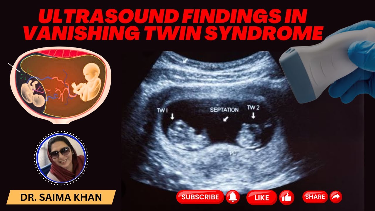 Ultrasound Findings in Vanishing Twin Syndrome #ultrasound  @Dr.Saimakhan