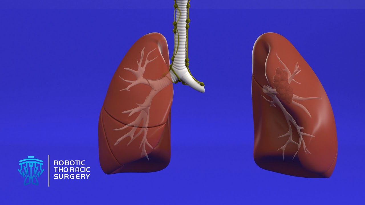 What Do I Need to Know About Lung Resection?