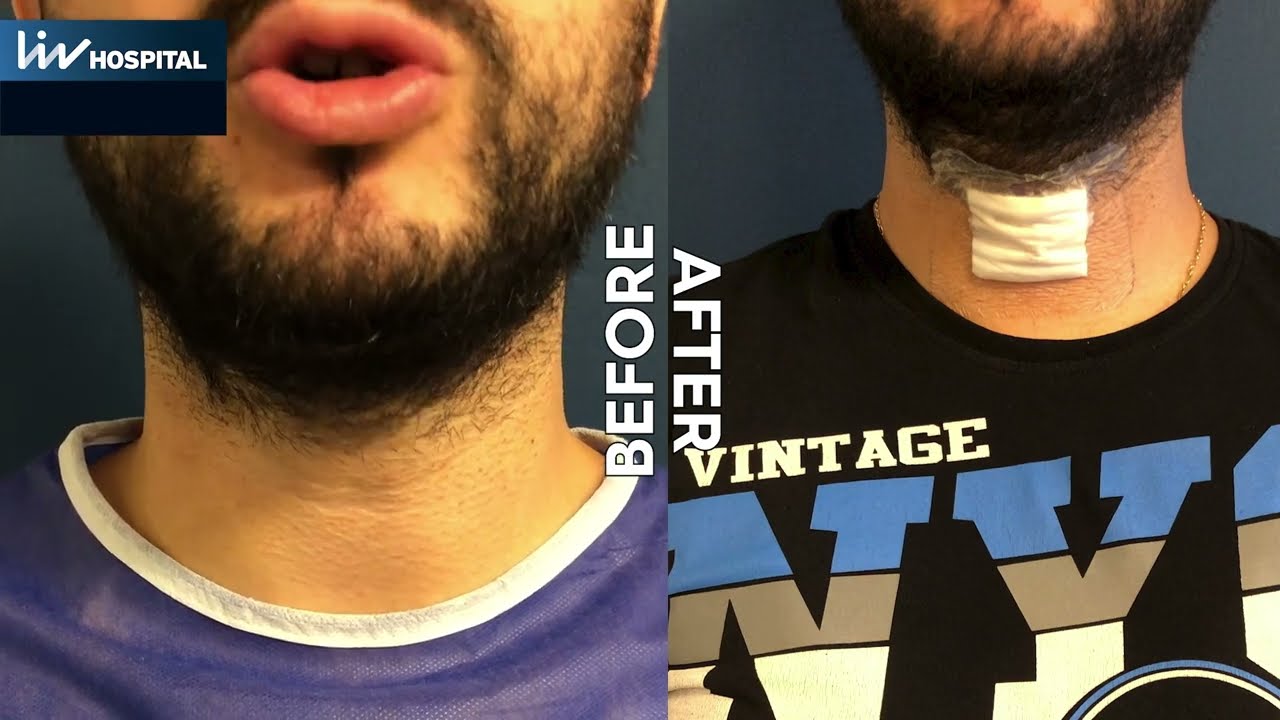 Patient Review: Voice masculinization surgery at Bookimed Partner Clinic - Liv Hospital