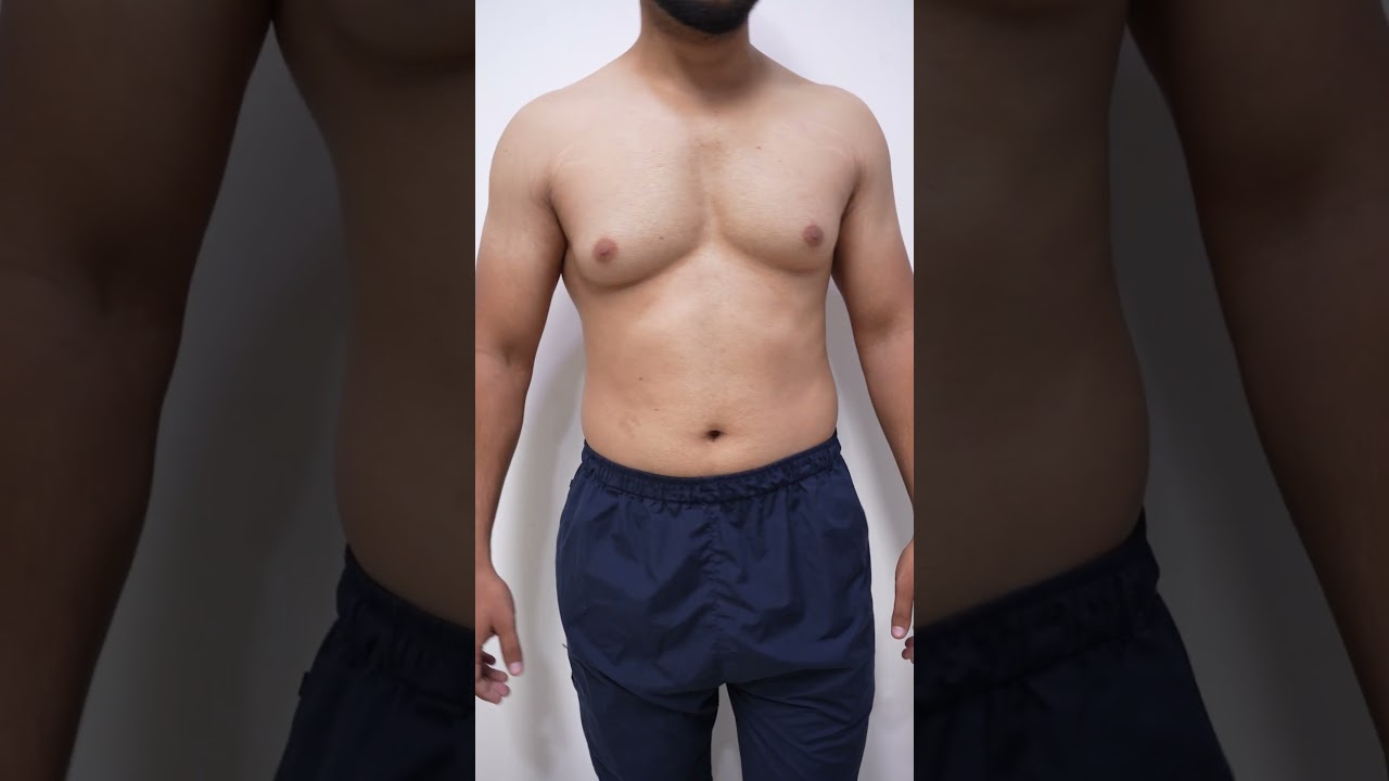 Gynecomastia Surgery before & After #shorts #ytshorts