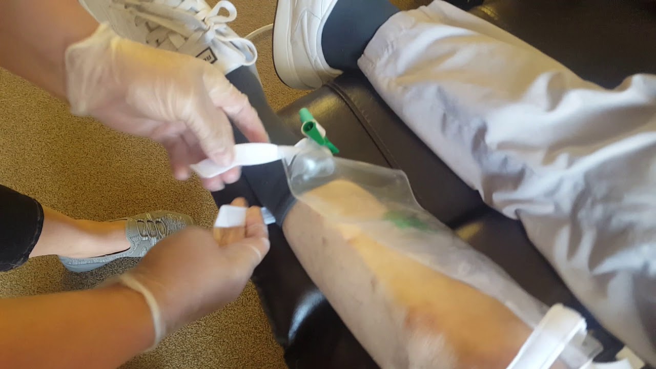 Catheter leg bag change