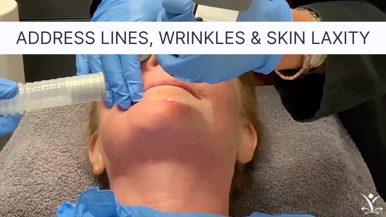 Laser Resurfacing with Contour TRL