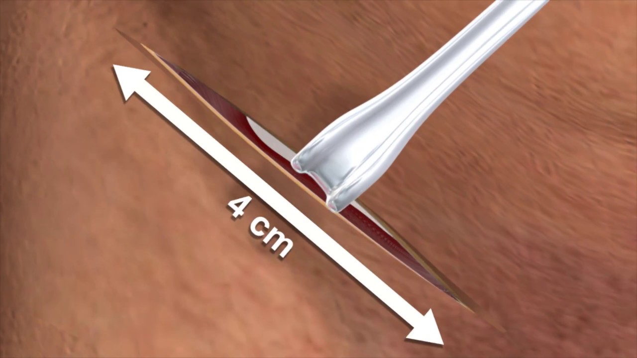 Inguinal hernia repair Perfix Light Plug graphic animation