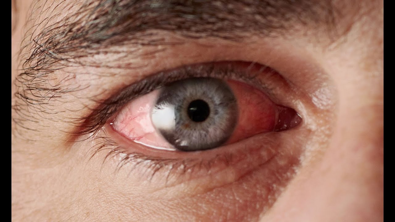 Hoe ontstaan Droge Ogen? Oorzaak plus vervolgstappen