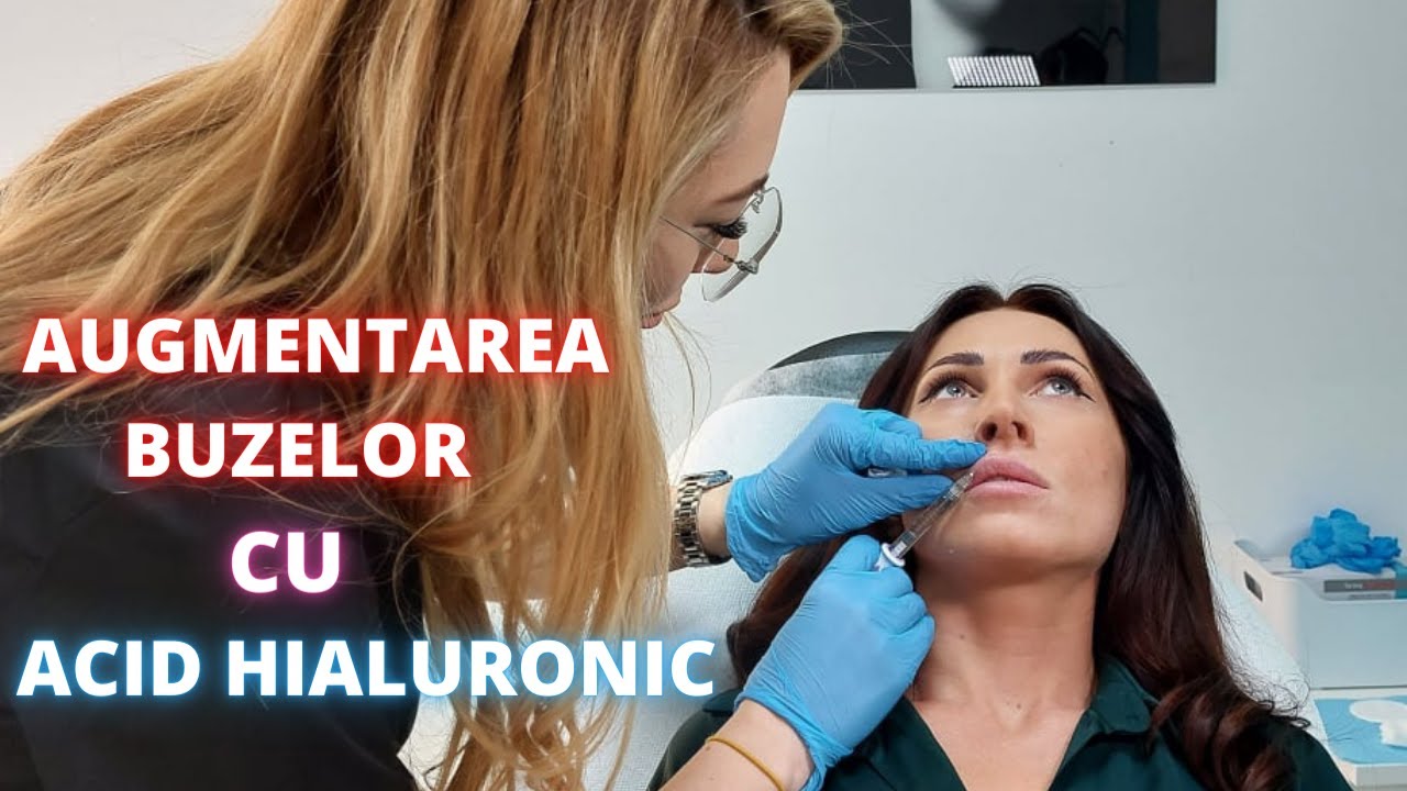 Volumizarea 💋 Buzelor cu Acid Hialuronic | DermaBeauty Clinique