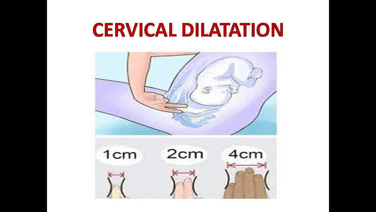 CERVICAL DILATATION