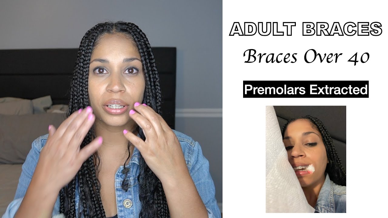 ADULT BRACES - BRACES OVER 40 - PREMOLAR EXTRACTIONS - NaturalsBest