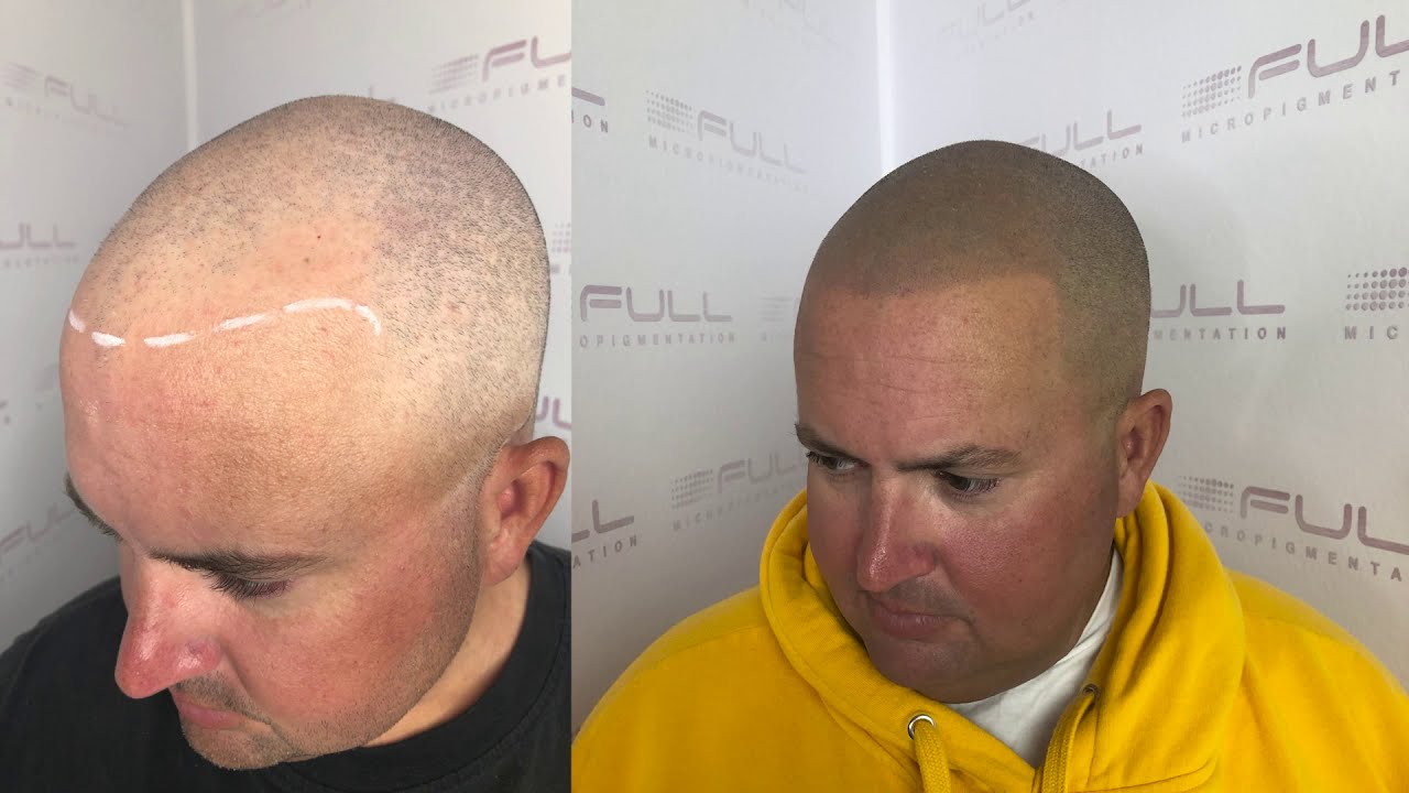 Healed Scalp Micropigmentation Results - Nevan's Journey with Balding and how SMP changed his life!