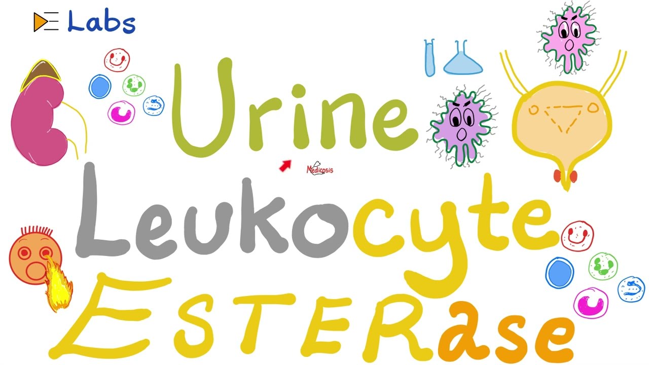 Esteraza leukocyt&oacute;w w moczu (analiza moczu) &ndash; zakażenia dr&oacute;g moczowych (ZUM) &ndash; lista odtwarzania ...