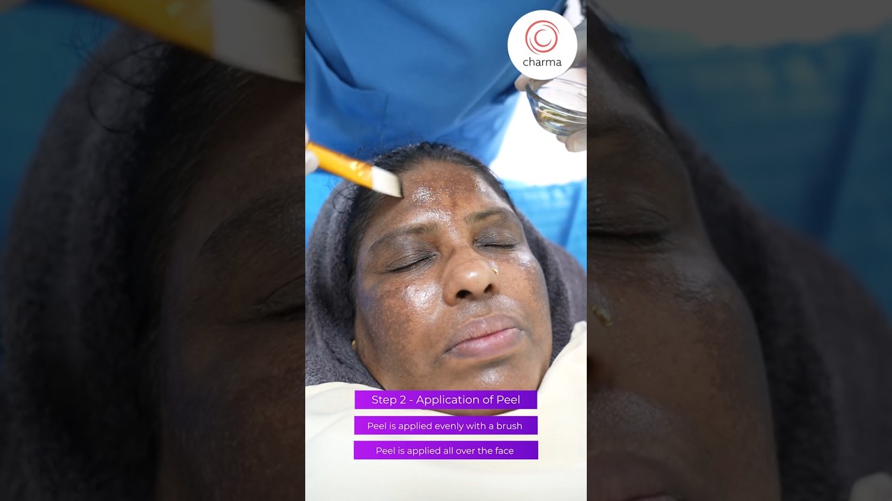 Chemical Peel For Melasma - Charma Clinic #shorts
