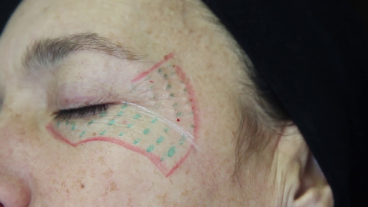 Jalupro + Botulinum Toxin Forhead and Periocular Wrinkles