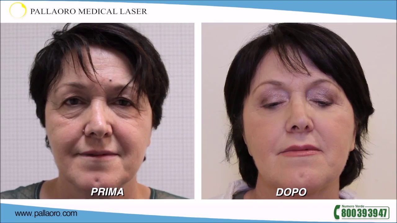Blefaroplastica e lifting viso: L' esperienza di Domenica