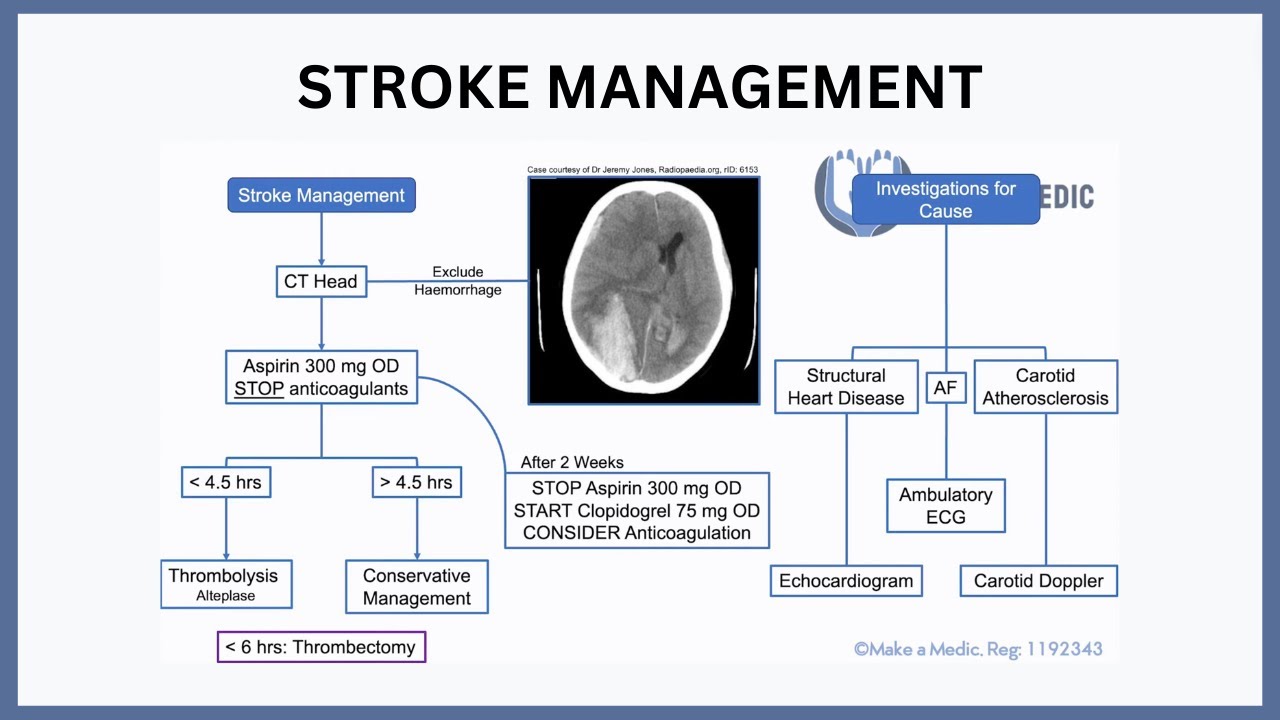 Stroke Management Explained