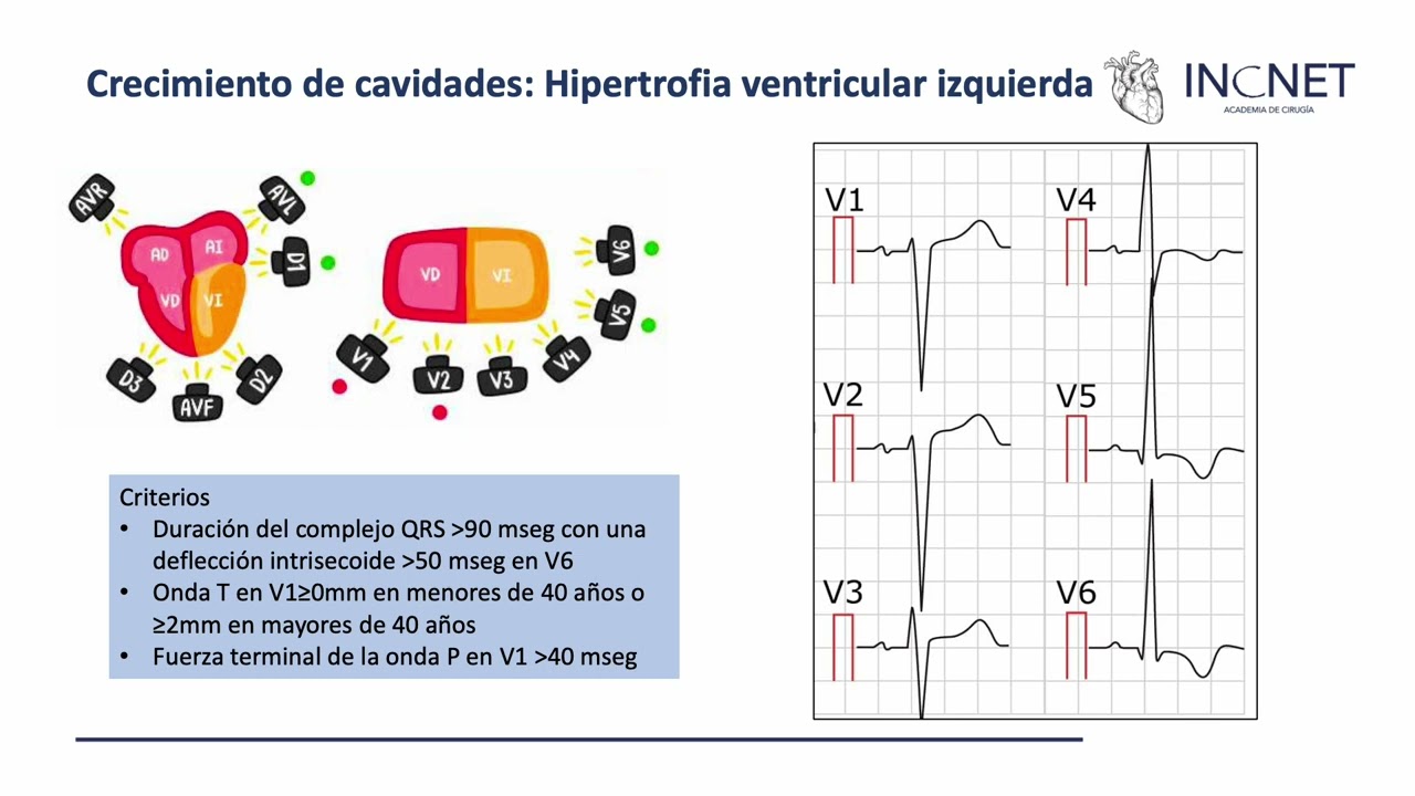 Electrocardiograma Anormal