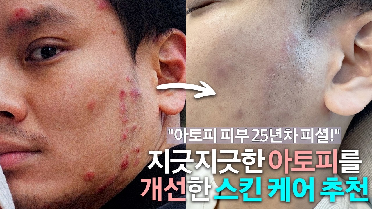 클렌징&스킨케어 초!민감성 피부 아토피 환자의 인생 루틴