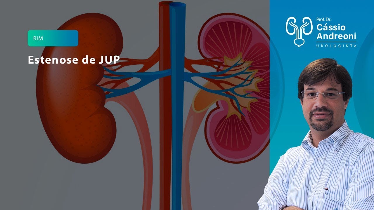 Estenose de JUP: sintomas e tratamento | Dr. Cassio Andreoni CRM 78.546