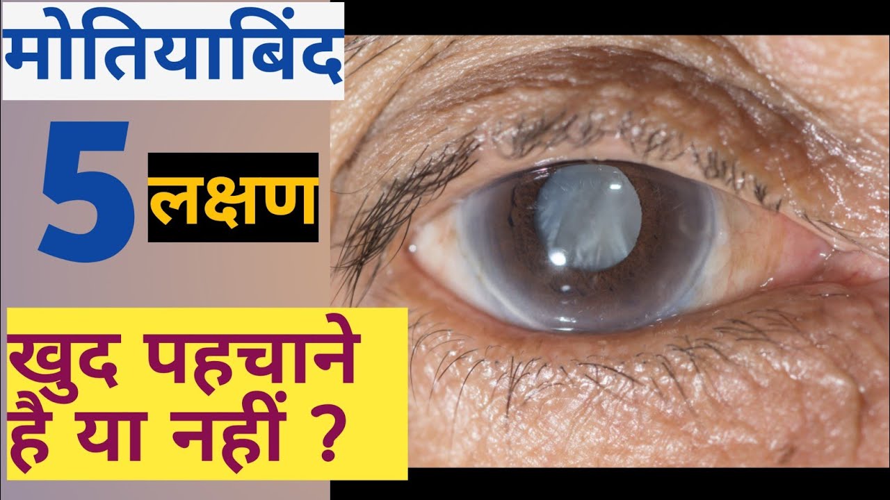 5 signs of cataract । motiabind ka operation। tension get out in hindi