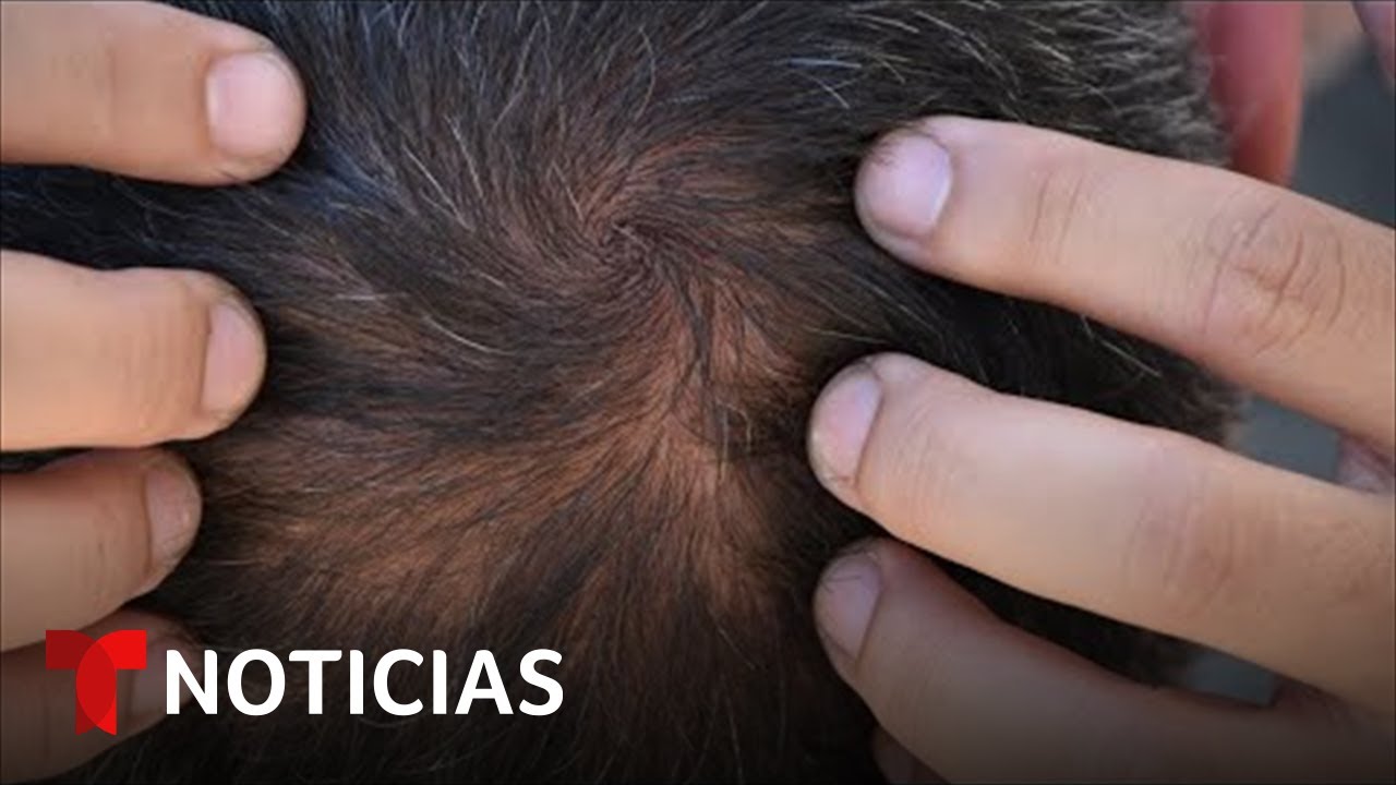 La FDA aprueba un medicamento contra la alopecia | Noticias Telemundo