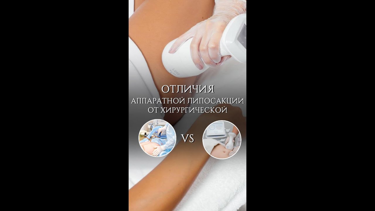 🤫Аппаратная и хирургическая липосакция- В ЧЁМ ОТЛИЧИЕ?!