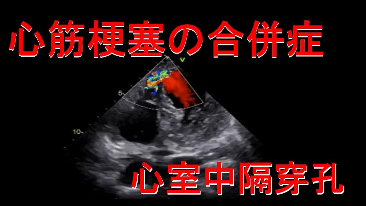 【心筋梗塞】予後が最悪…AMIの合併症の症状・治療法