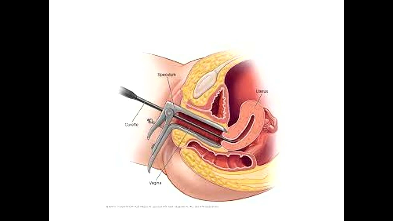Bleeding in early pregnancy