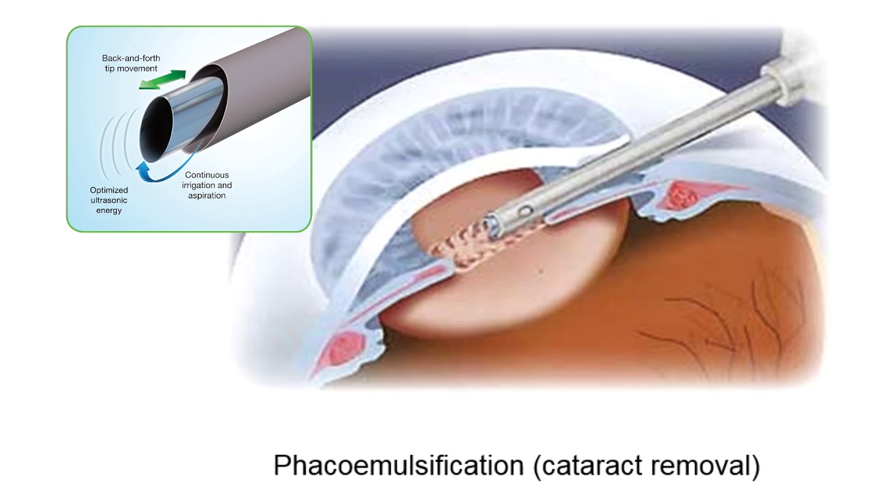 Basics of Musculoskeletal Ultrasound