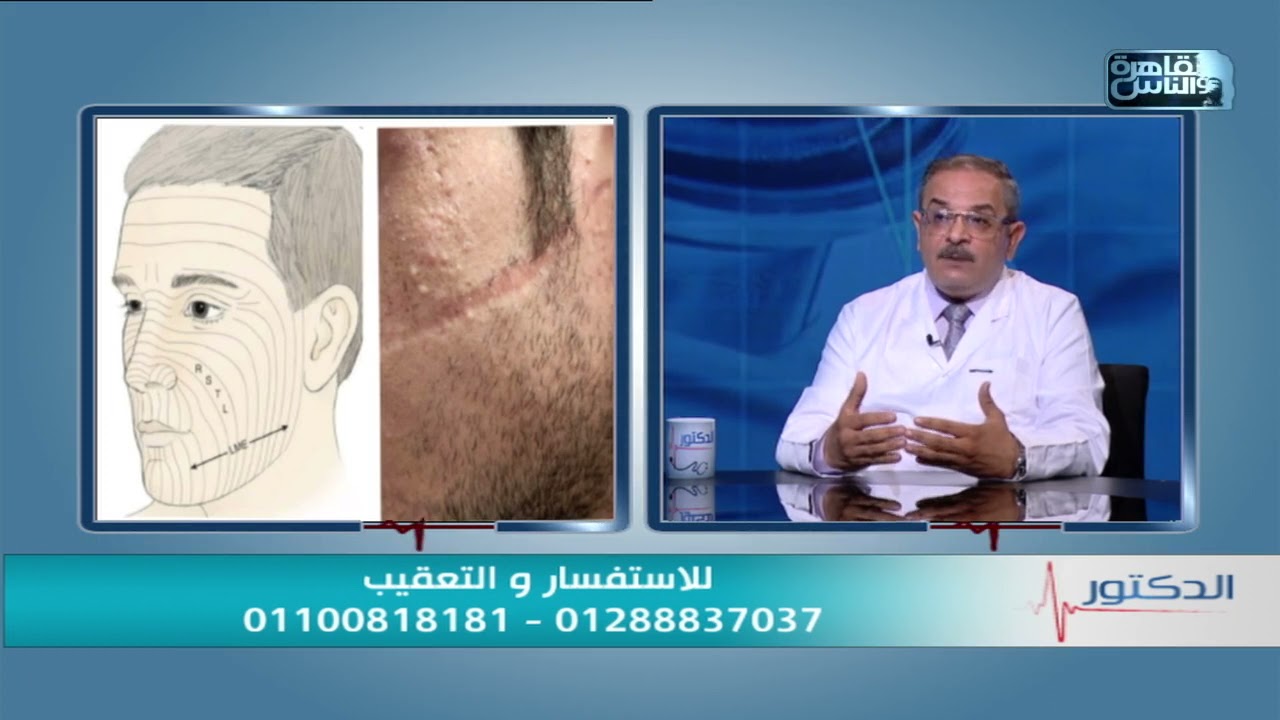 الدكتور | انواع ندبات الوجه وطرق إزالتها وتجميلها مع دكتور موريس فكرى