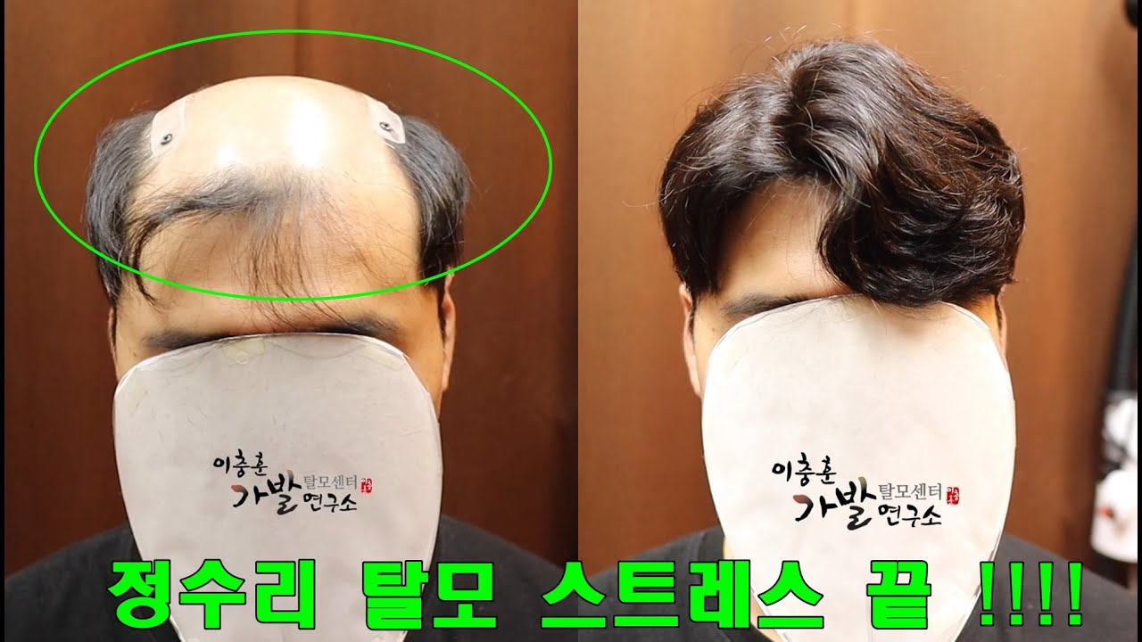 정수리 탈모는 정수리 가발로 완치!! (이충훈가발연구소)