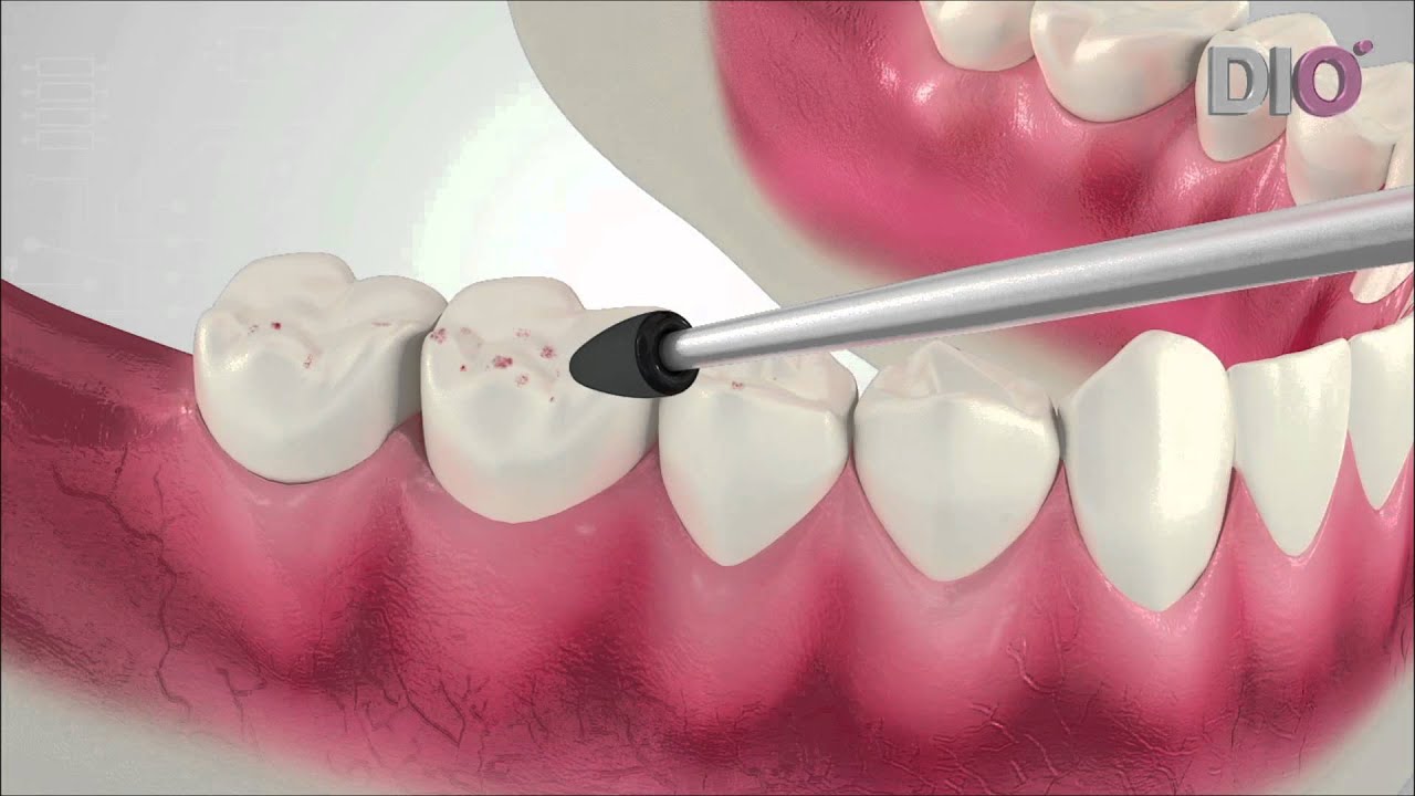 What is a dental implant? Dental implant patient movie by DIO Implants