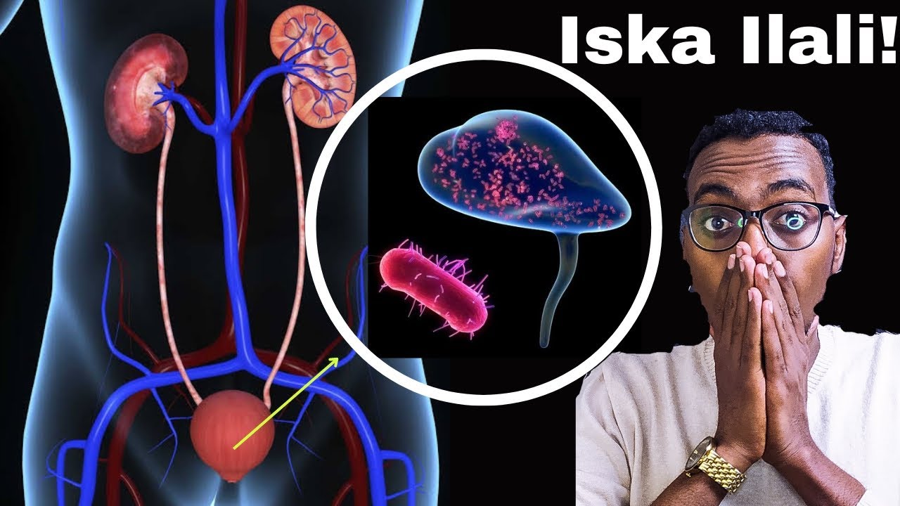 Si Fudud Ku Baro Astaamaha Infekshinka Kaadi Haysta| Dr Sadam