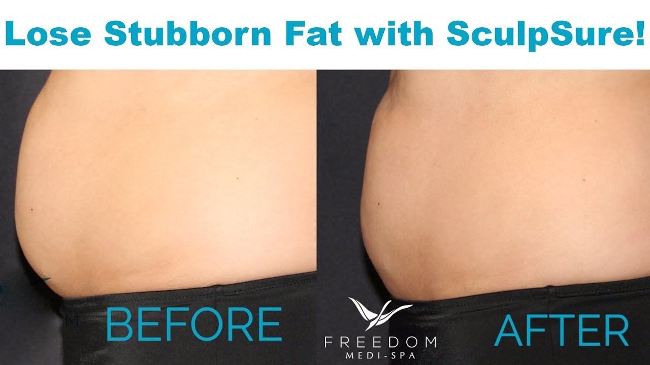 Diana's SculpSure Journey - SHOCKING Before & After