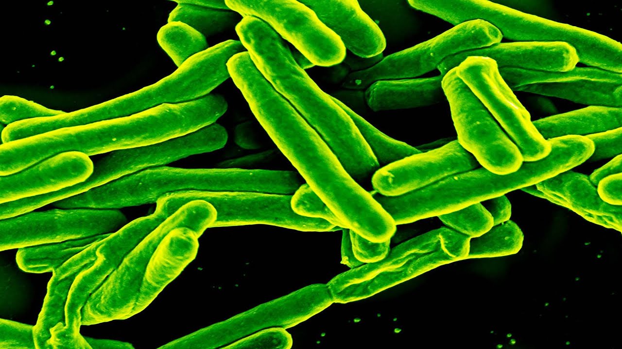 Tuberculosis meníngea y embarazo - Dr. Jhonnys Maluenga Álvarez