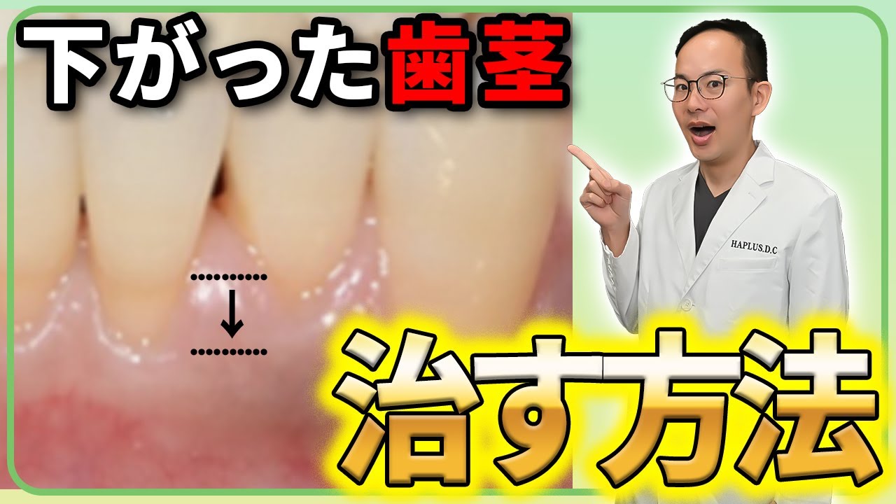加齢と共に歯茎は下がります...そんな歯肉退縮を治す方法について必死に考えてみました！【歯茎下がり】