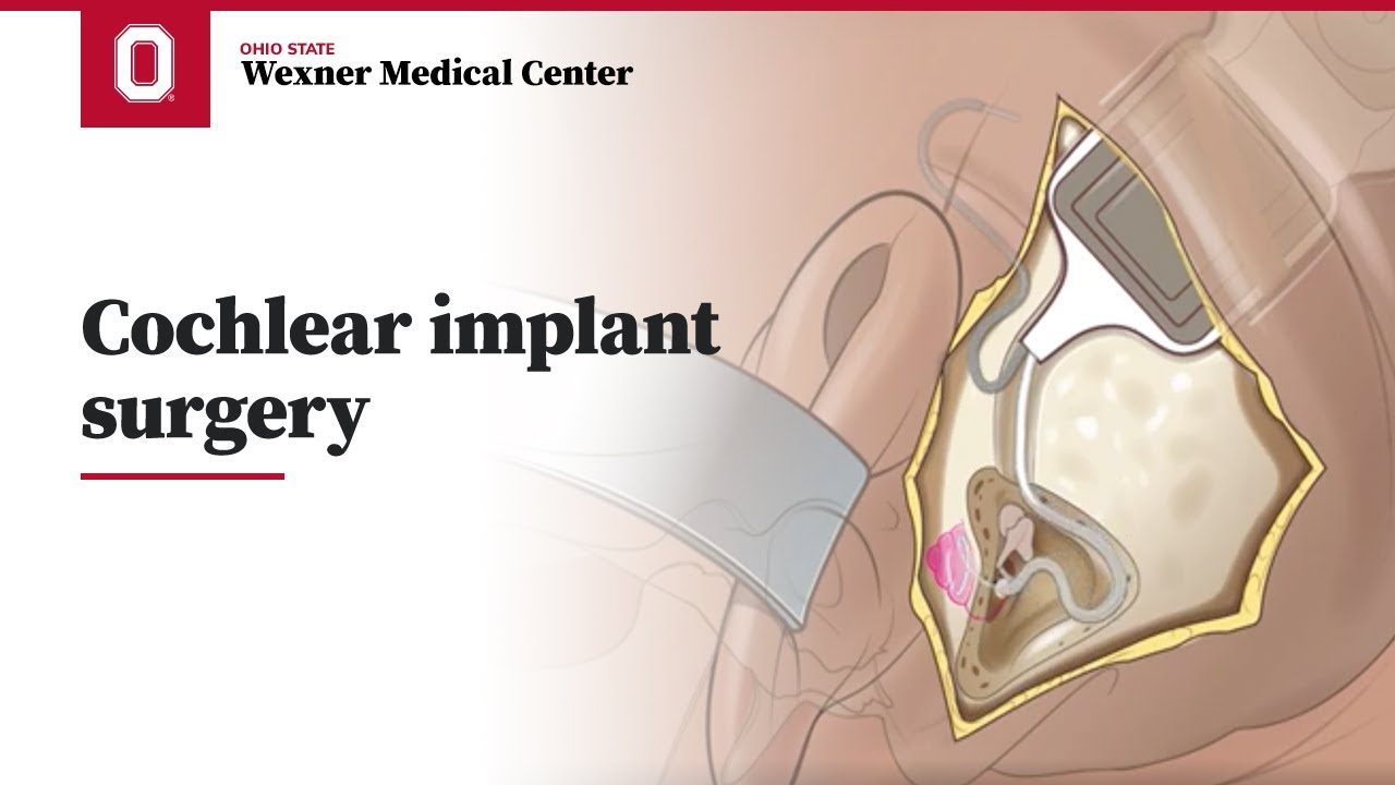 Cochlear implant surgery | Ohio State Medical Center