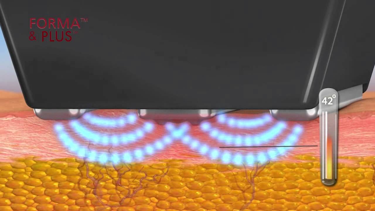 Forma - Non-Surgical Radiofrequency Treatment for Wrinkles