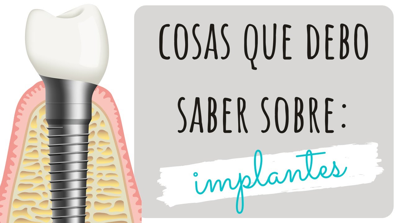 📌 DIENTES Vs IMPLANTES📌  ¿qué debo saber?