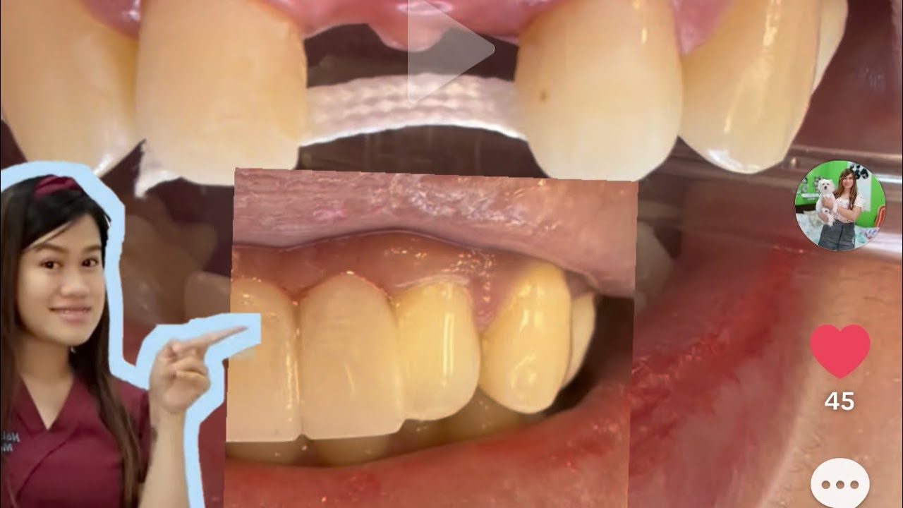 FIBER REINFORCED COMPOSITE BRIDGE dental clinic in kuwait