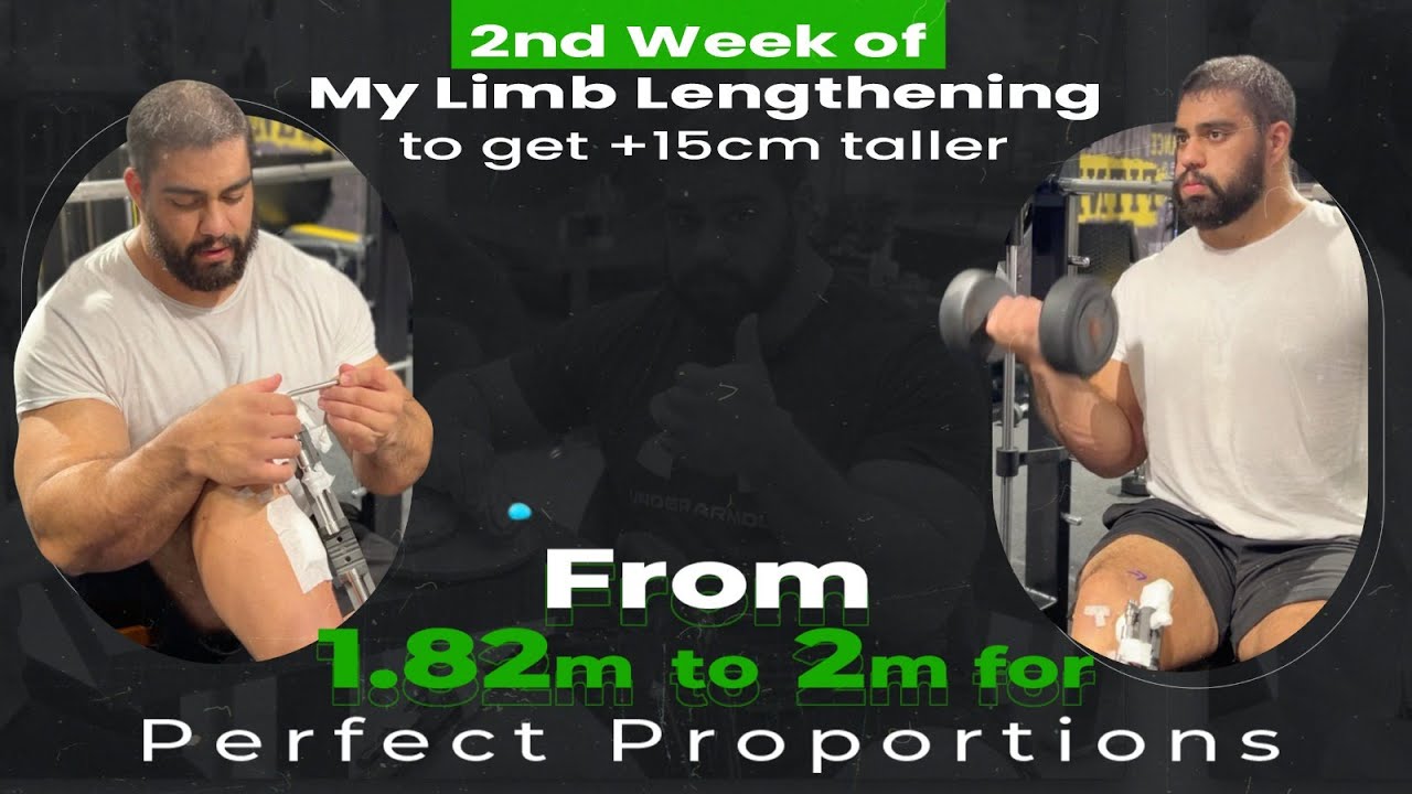 2nd Week of My Limb Lengthening to get +15 cm taller | From 1.82m to 2m for Perfect Proportions