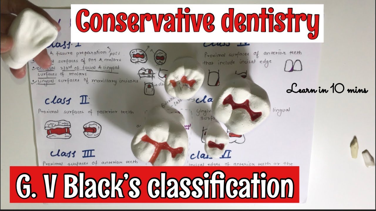G. V. BLACK’S CLASSIFICATION OF TOOTH PREPARATION || CONSERVATIVE DENTISTRY || *imp