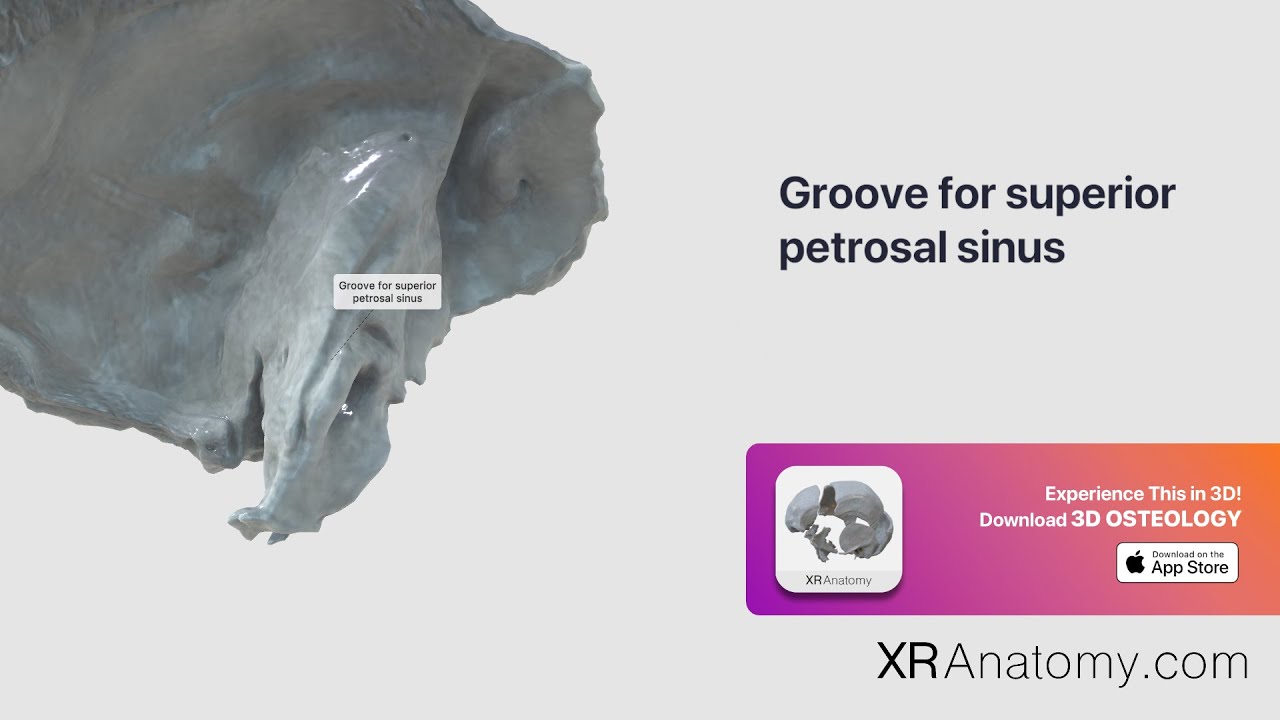 Temporal Bone - Groove for superior petrosal sinus