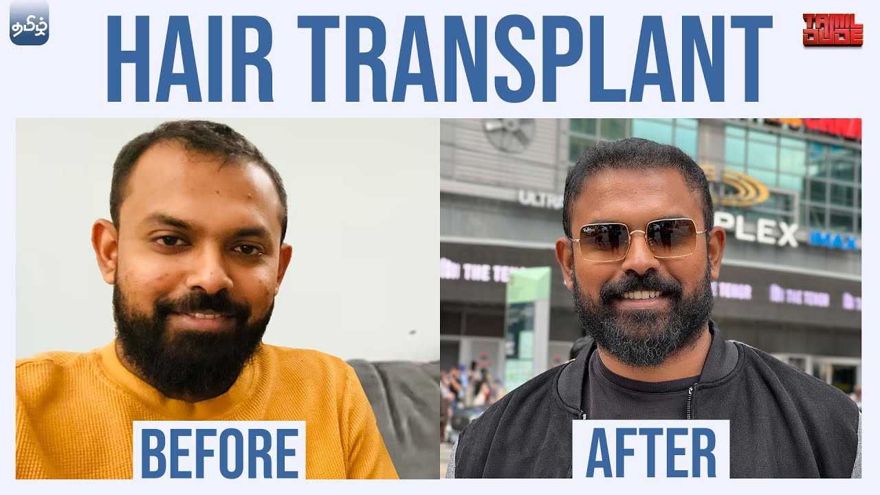 Hair Transplant FUE vs FUT vs PRP vs Hair System - Full Process explained in Tamil | Tamil Dude
