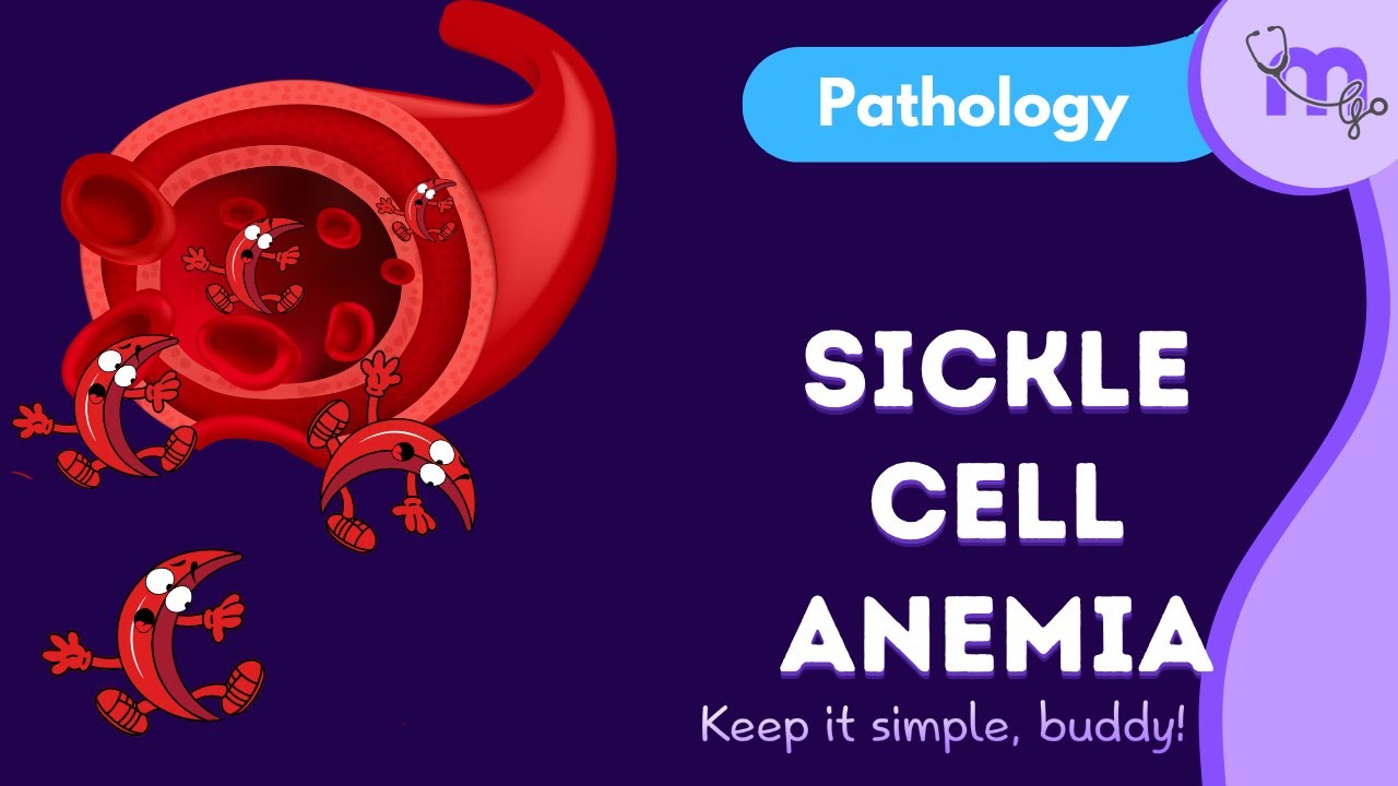 Sickle Cell Anemia Explained | Pathogenesis, Peripheral Smear, Radiology & Dental Considerations