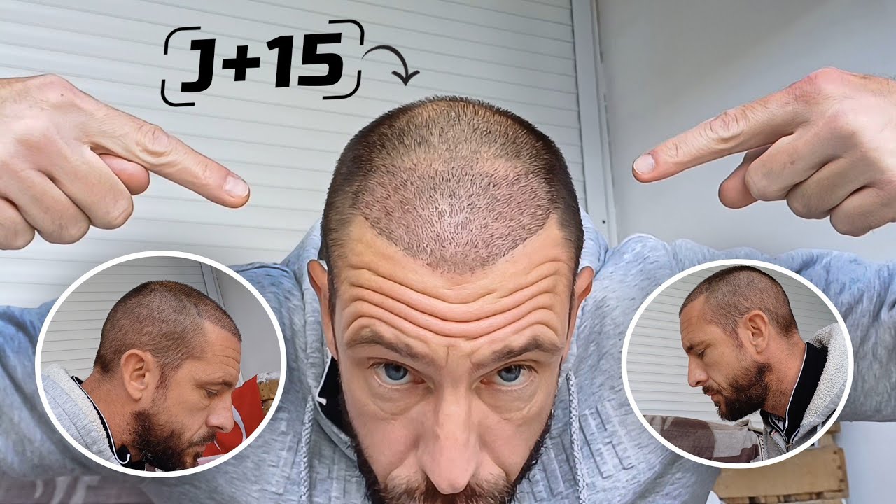 🟢J+15 [BILAN] Greffe de Cheveux en TURQUIE 🇹🇷 (je dis NON au Minoxidil et Finastéride😒)