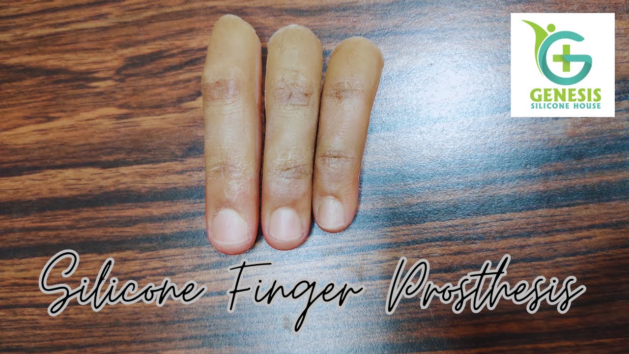 Revolutionary Silicone Finger Prosthesis: Enhancing Hand Mobility and Functionality
