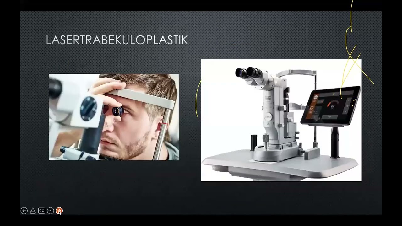 Laser bei Glaukom: SLT, CPC, Iridotomie etc. - Was bringen diese Techniken? Wem nützen sie?