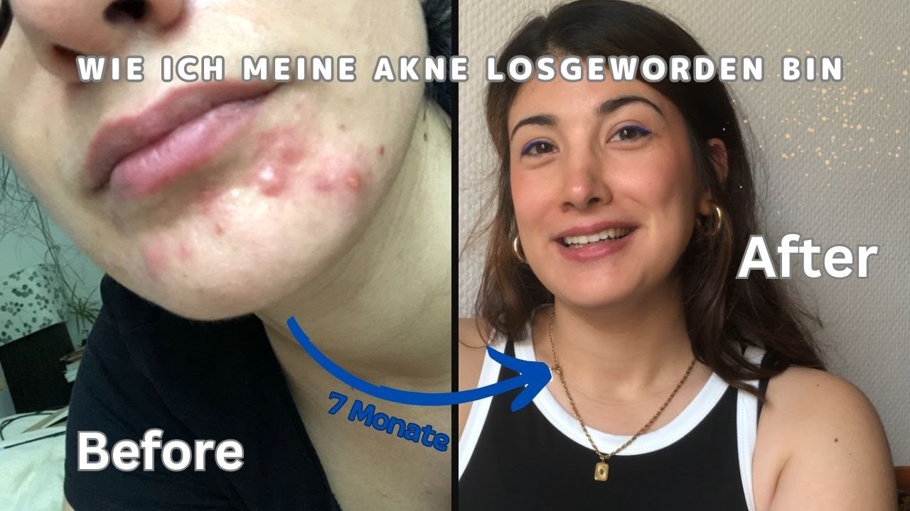 Nach all den Jahren endlich schöne reine Haut! Akne loswerden - Isotretinoin Therapie & Erfahrung