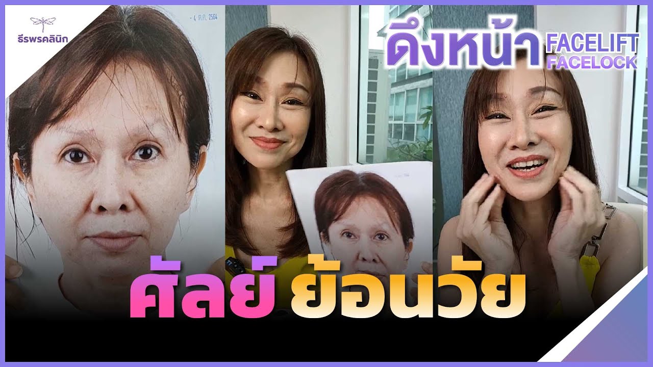 ดึงหน้า แค่ 3 วัน เห็นหน้าตัวเองแล้วคิดถึงพ่อ😆😆😆 เลยมาทำFace-Lock ธีรพรคลินิก หมอชลธิศ